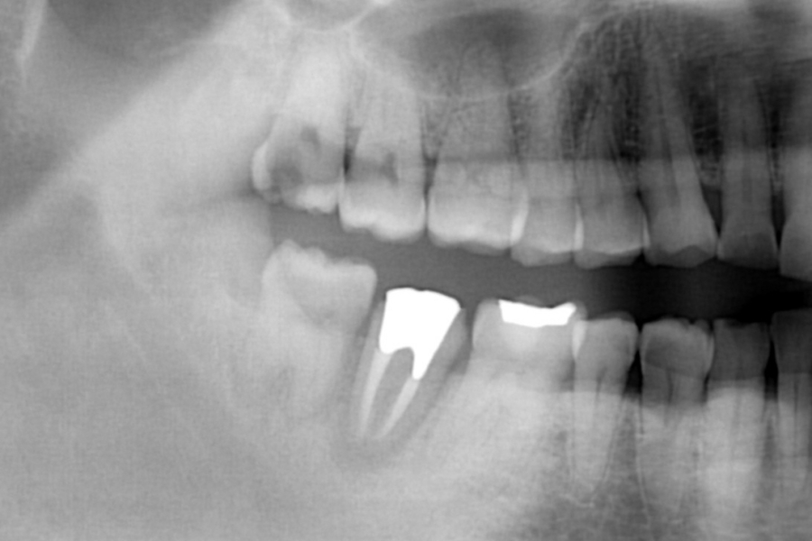 自家歯牙移植｜症例集｜ブログ｜用賀の歯医者｜ヒラノデンタルオフィス