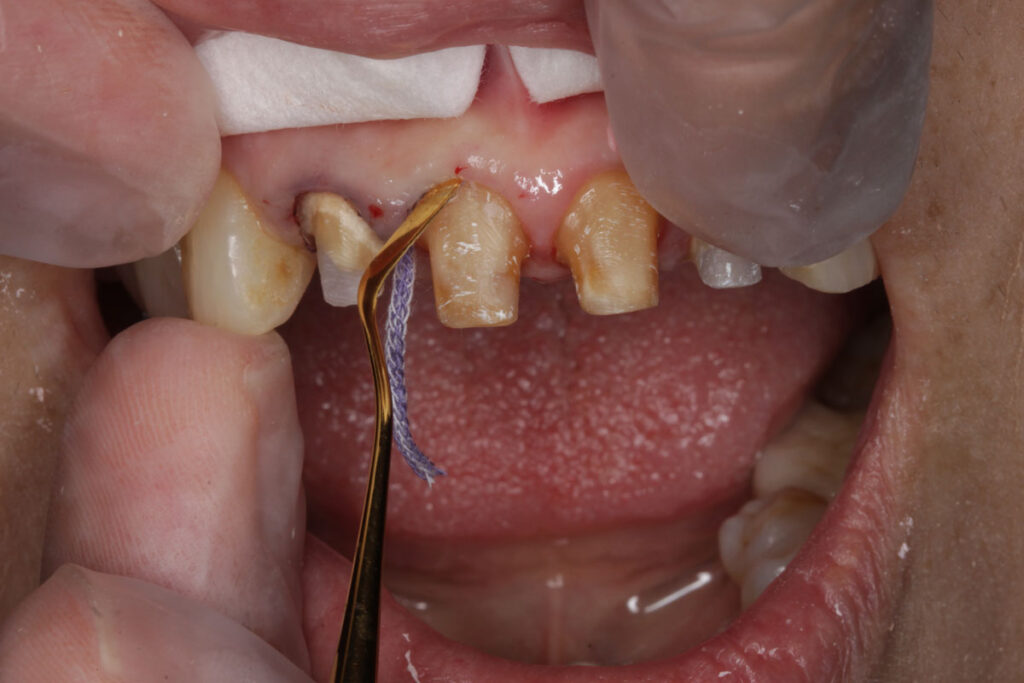 歯と歯茎の間を糸で広げます