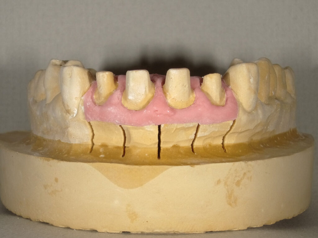 歯ぐきの模型