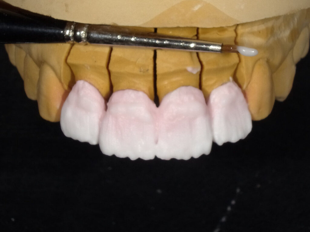 歯茎部の象牙質